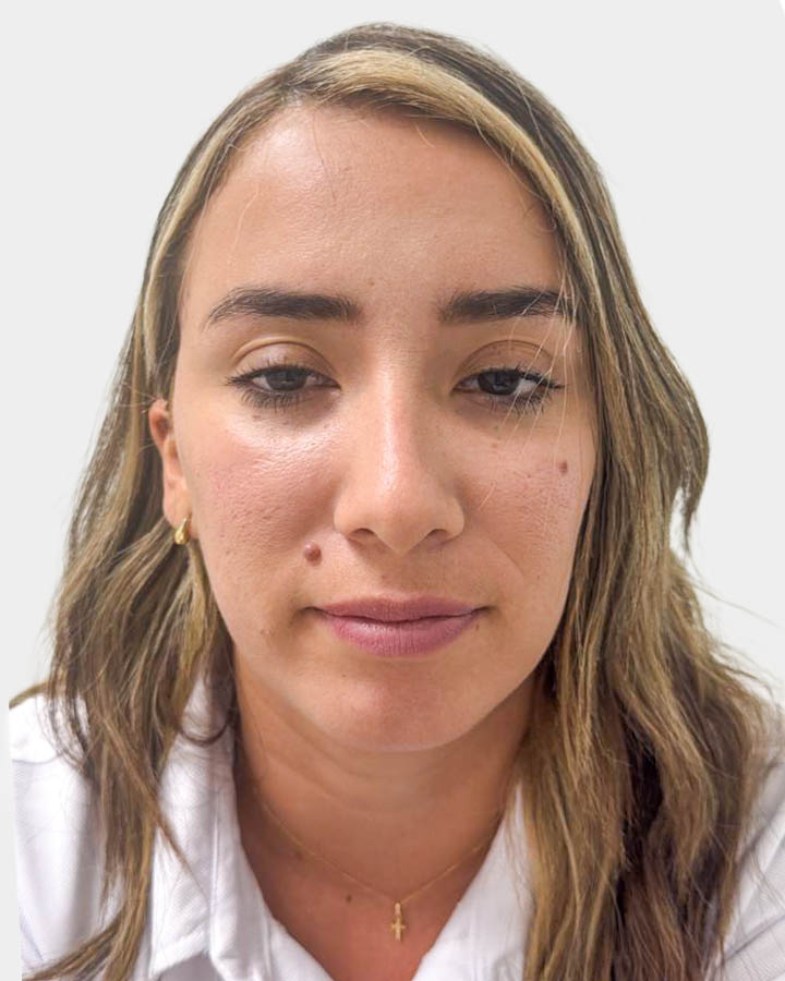 Antes de Retiro de Lunares